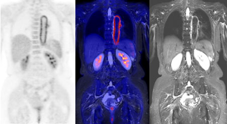 Pictures PET and MR, merged in the middle Picture PET/MR